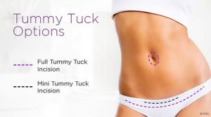 Picture of a typical tummy tuck procedure.