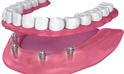 Illustration of an All-on-Four dental implant procedure in Costa Rica.