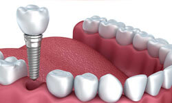 Illustration of a dental implant procedure in Costa Rica.