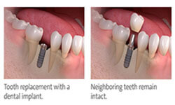 Illustration of how a dental implant crown is placed on a dental implant.
