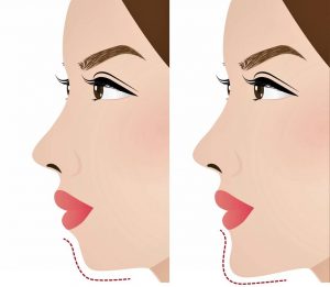 Before and After illustration of a female with a chin implant.