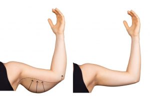 Picture of a before and after arm lift procedure in Dallas, TX