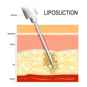 Illustration of Tumescent liposuction
