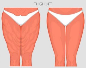 Illustration of an inner and outer thigh lift