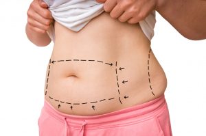 Areas of 360 Liposuction in Costa Rica