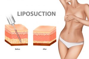 Illustration showing how Tumescent liposuction is done
