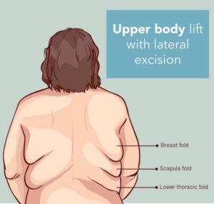 Illustration of areas of an upper body lift
